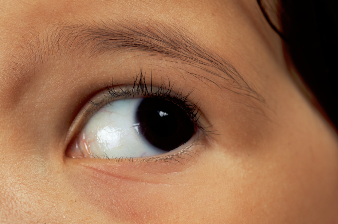 Aniridia o ausencia de iris. ¿Afecta a la visión?