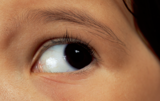Aniridia o ausencia de iris. ¿Afecta a la visión?