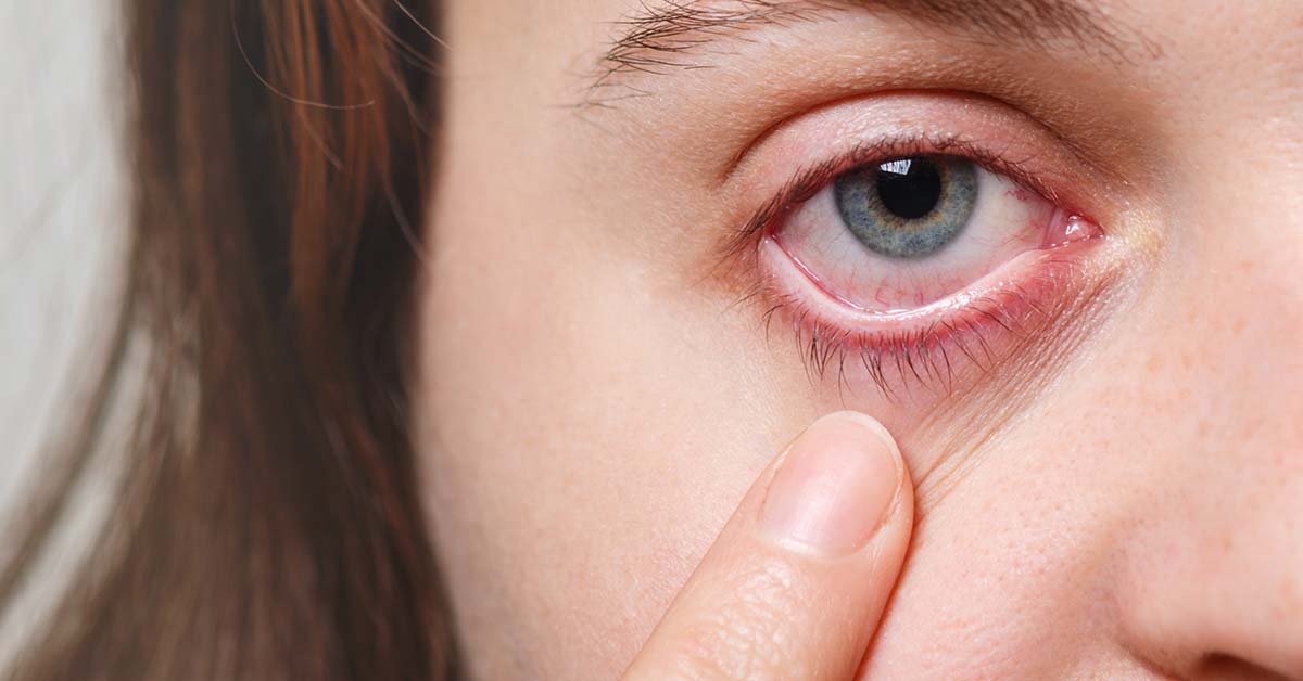 ¿Cómo afectan las alergias en lo ojos?