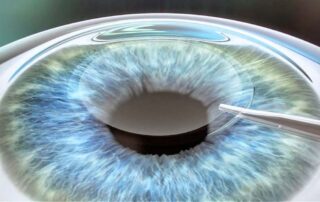 LASIK vs ReLEx SMILE: Diferencias, ventajas y recuperación