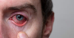 Conjuntivitis: tipos, prevención y tratamiento