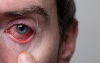Conjuntivitis: tipos, prevención y tratamiento