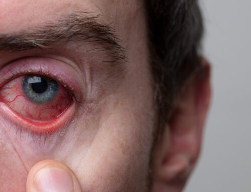 Conjuntivitis: tipos, prevención y tratamiento