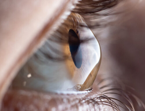 Qué es el cross-linking y cómo ayuda en el queratocono